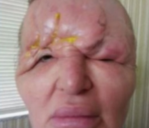 美女が整形手術失敗で驚きの顔に 術後の副作用がひどい 後遺症で失明も